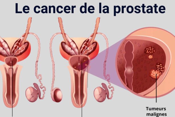 cancer de prostate