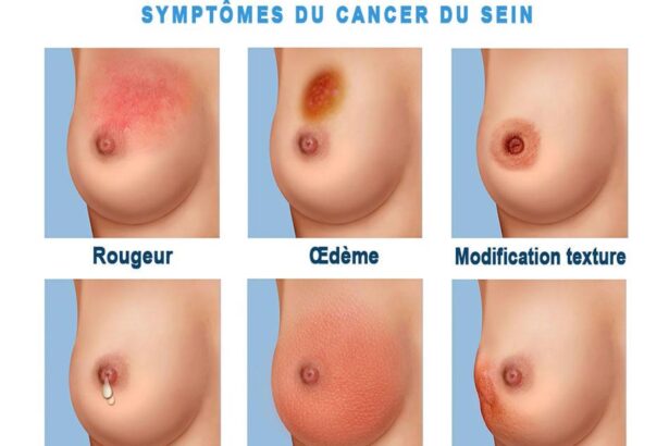 cancer du sein